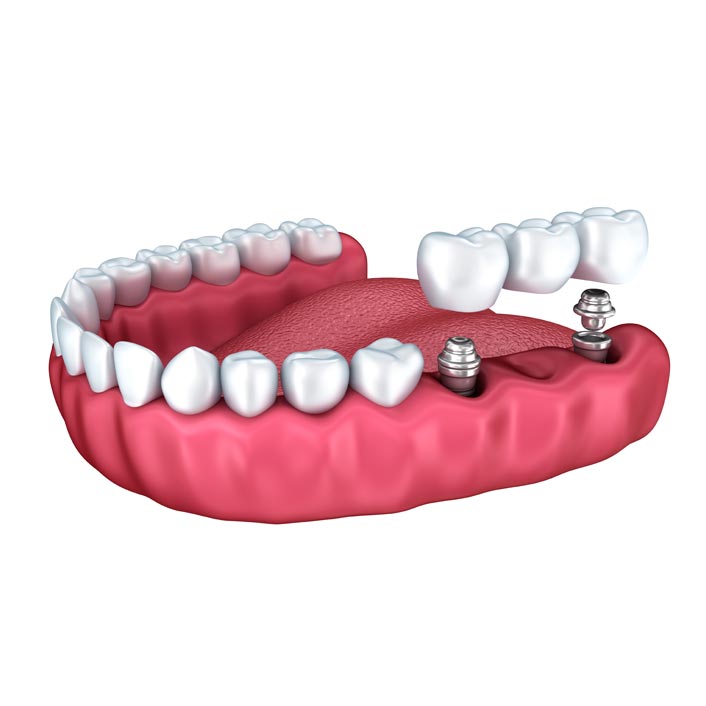 tooth bridge implant