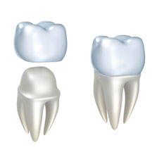 tooth crown example